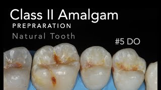 Class II Amalgam Preparation  5 DO Natural Tooth [upl. by Laehcimaj206]