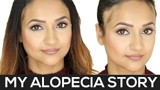 My Alopecia Story  Alopecia Areata [upl. by Michel]