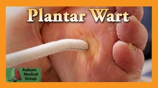 Plantar Wart Treatment  Auburn Medical Group [upl. by Eelyram]