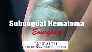 Subungual Hematoma Emergency and Trephination Procedure [upl. by Secunda]