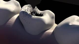 3d Animation of Caries Removal amp The Cavity Filling Procedure  NYC Dentist  Dr Simon Rosenberg [upl. by Josias]