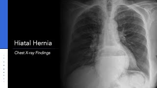 Hiatal Hernia Chest Xray [upl. by Shewmaker239]