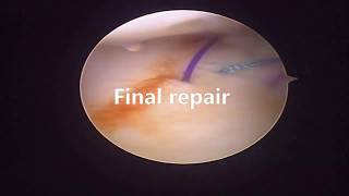 Ulnar TFCC repairSurgical steps [upl. by Zelle]