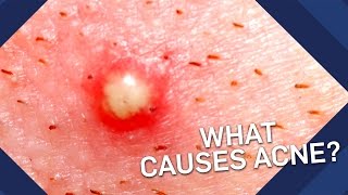 What Causes Acne  Earth Science [upl. by Mitch]