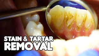 Dental Cleaning EXPLAINED  Stain amp Tartar Removal [upl. by Lederer]