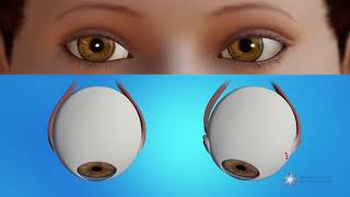 Ophthalmology 353 Strabismus Squint Why does it happen Basic concepts Eye Movement Define [upl. by Ocirred]