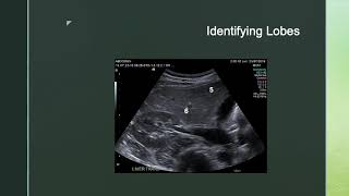 Liver Haemangioma Gross and Micro [upl. by Alywt]