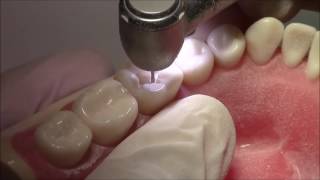 Tutorial on Class I Cavity Preparation Amalgam Restoration  DENTALKART [upl. by Eityak]