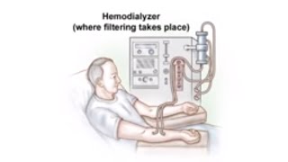 Dialysis Access and Fistula Procedure [upl. by Ateekan]