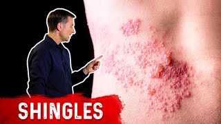 Shingles Natural Relief [upl. by Delfeena689]