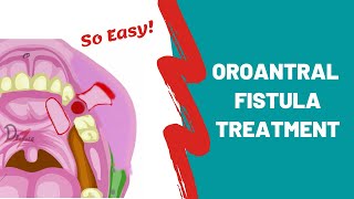 Oroantral Fistula  Treatment Options  ORAL SURGERY [upl. by Aissilem]