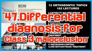 47Differential diagnosis for Class 3 malocclusion [upl. by Reinke]