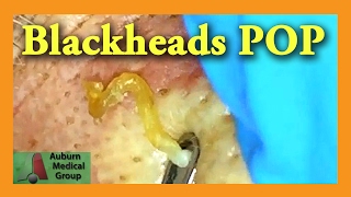 Blackheads POP  Auburn Medical Group [upl. by Novert]