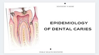 EPIDEMIOLOGY OF DENTAL CARIES [upl. by Ojok]