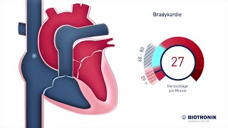 Langsame Herzrhythmusstörungen Bradykardie [upl. by Kind]