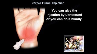 Carpal Tunnel Injection  Everything You Need To Know  Dr Nabil Ebraheim [upl. by Asillam]