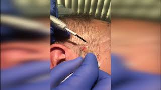 Seborrhoeic Keratosis Removal Demo [upl. by Zrike]