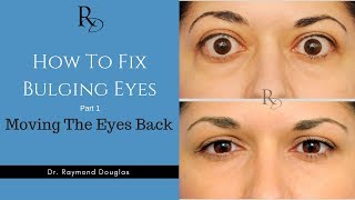 How To Fix Bulging Eyes  Part 1  Moving The Eyes Back [upl. by Swor]