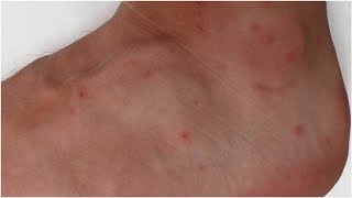 How to Identify and Treat Mite Bites  Tita TV [upl. by Hew219]