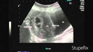 Ultrasound video of subchorionic hematoma early pregnancy [upl. by Pelpel]