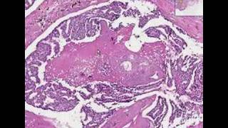 Breast Cancer Subtypes Understanding Invasive Ductal Carcinoma [upl. by Connor745]