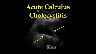 How To Gallbladder Ultrasound Part 3  Acute Cholecystitis Case Study Video [upl. by Jeconiah251]