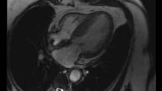 Cardiac MRI  Severe hypertrophic obstructive cardiomyopathy [upl. by Silverstein137]