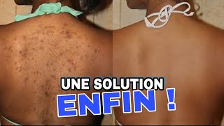 BOUTONS DANS LE DOS  ACNE ON BACK TREATMENT [upl. by Anuahc]