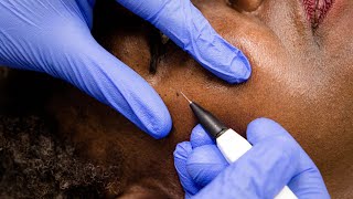 Skin Tags Removal with Electrolysis [upl. by Abehshtab]