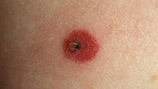 How to Spot Lyme Disease  WebMD [upl. by Llovera]