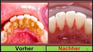 KEIN SCHERZ Entferne deinen Zahnbelag in 2 Minuten ohne zum Zahnarzt zu gehen [upl. by Arimat]