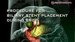 Biliary Stent [upl. by Cosette54]