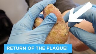 RETURN OF THE PLAQUE  PSORIATIC PLAQUE PART 2 [upl. by Ellette]