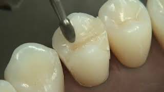 Class II Composite Preparation amp Restoration  Operative Dentistry [upl. by Norval]