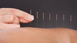 The Science Behind How Acupuncture Helps Relieve Pain A Doctor Of Chinese Medicine Explains [upl. by Kaliski458]