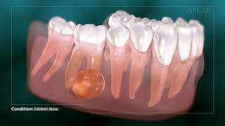 Dental Abcess  Why Root Canal Treatment Is Needed [upl. by Crosley]