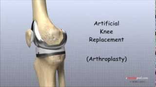 Artificial Knee Replacement [upl. by Aniloj]