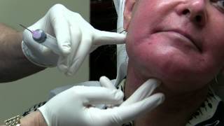 Facelift Seroma Aspiration by Dr Joe Niamtu III [upl. by Issak]