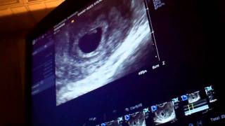 Ultrasound 6 weeks 3 days [upl. by Jacobah]