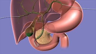 Introduction to Biliary Ultrasound [upl. by Eicnan199]