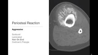 Bone Tumors  Periosteal Reaction  Radiology Basics [upl. by Mathis]