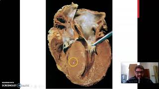 Miocardiopatia Hipertrófica [upl. by Anrak]