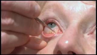 Oculoplastics basic exam Lacrimal system examination [upl. by Turne65]