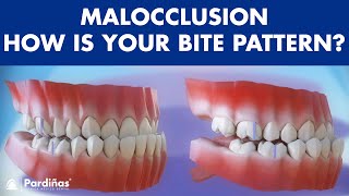 Malocclusion  Bite patterns © [upl. by Venu]