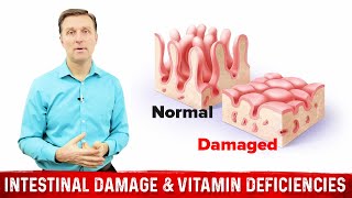 Intestinal Obstruction amp Vitamin Deficiencies – Dr Berg [upl. by Conover260]