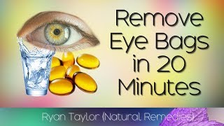 How To Remove Eye Bags 20 Minute Natural Remedies [upl. by Solana93]