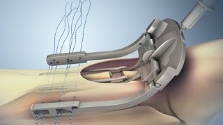 Achilles Tendon Rupture and Repair [upl. by Doownel587]