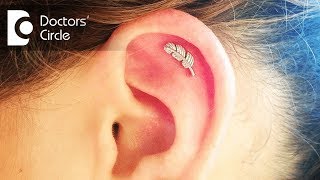 How to manage an infected cartilage of helix post Ear Piercing  Dr Harihara Murthy [upl. by Assirehc]