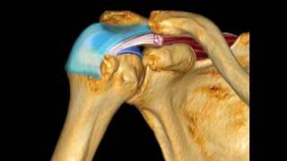 How To Supraspinatus Pathology Case Study Video [upl. by Rempe]