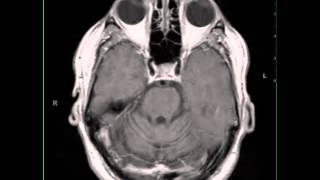 Paraneoplastic Cerebellar Atrophy [upl. by Hanas732]